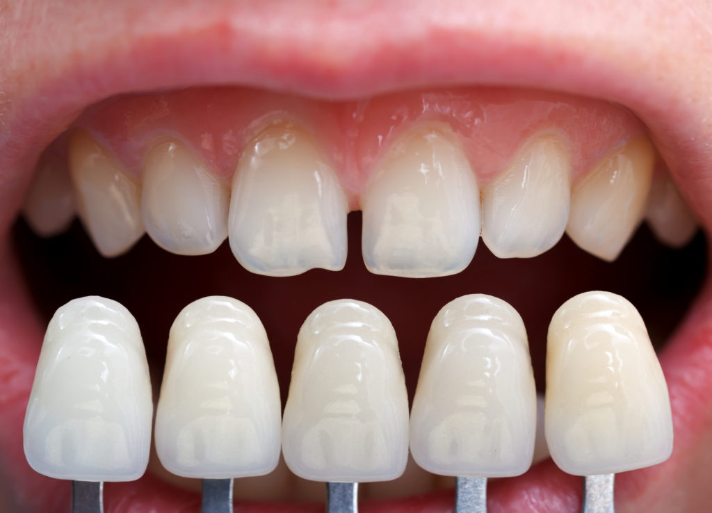 Getting dental veneers includes doing a shade determination with the help of a shade guide.