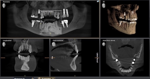 CBCT digital x-rays