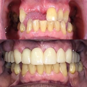 before and after results of using dental implants and dental crowns to restore a patient's smile